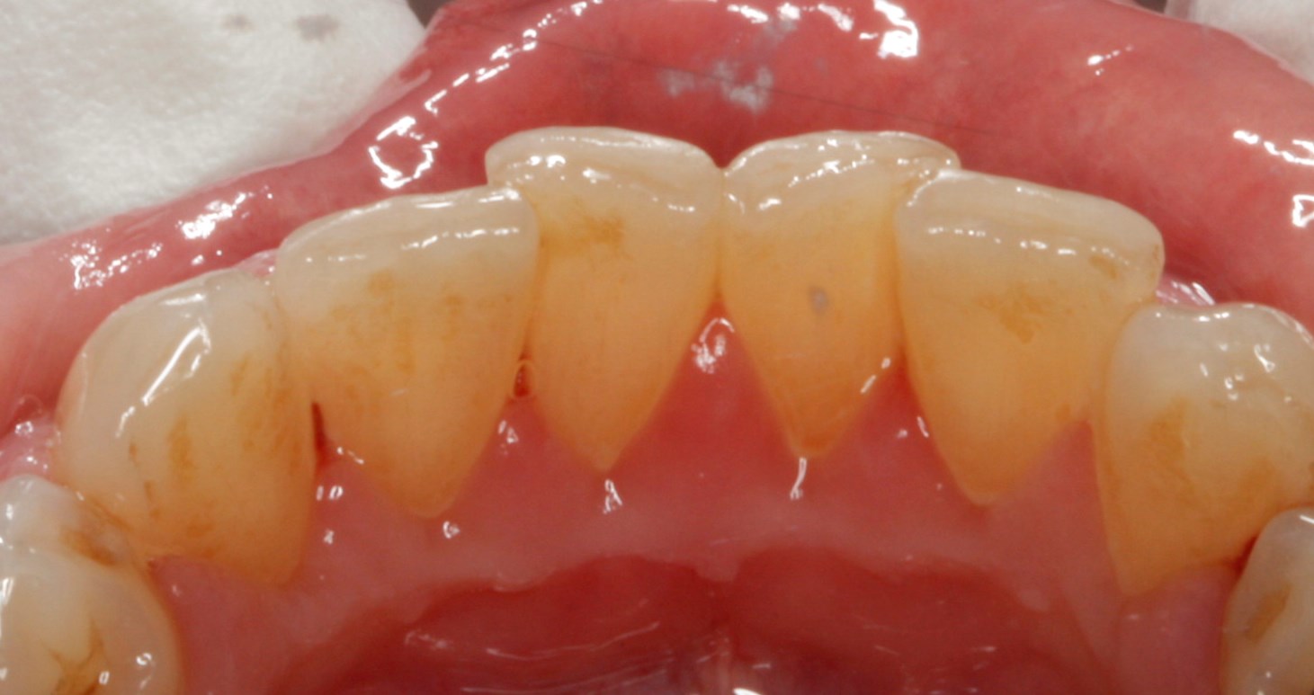 Tannkjottbetennelse Gingivitt Felleskatalogen