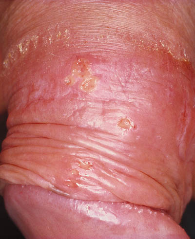 Genitalis frau herpes Herpes simplex